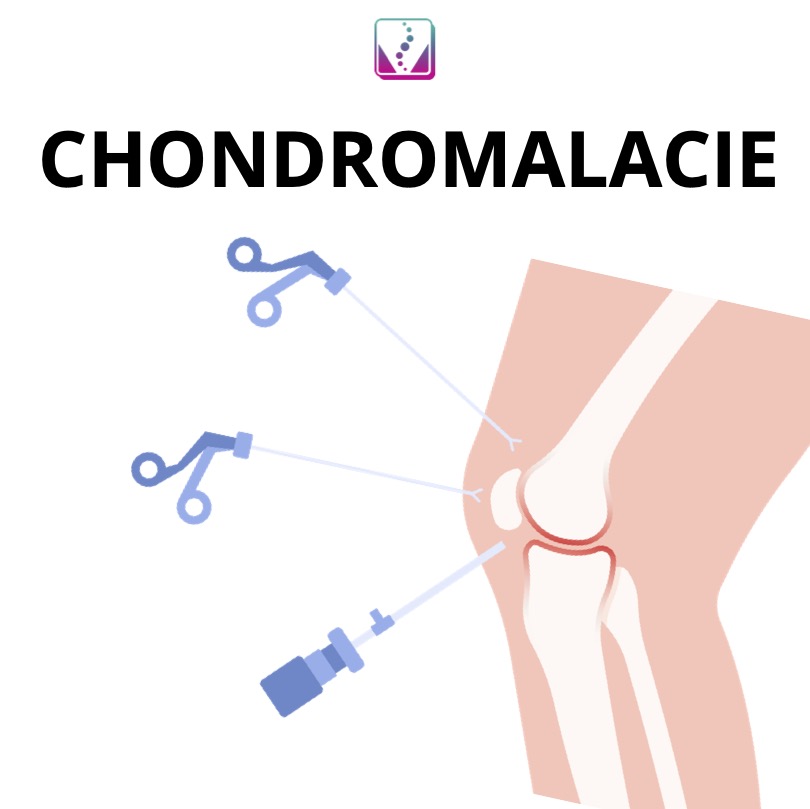 Chondromalacie